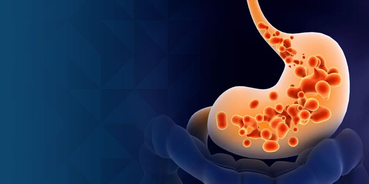 Living with GERD: Diet, Lifestyle Changes & Advanced Treatment Options